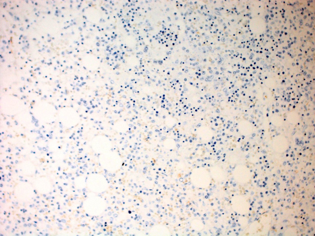 Atypical lymphoid cells are negative for CD56 (Immunoperoxidase, 200x)